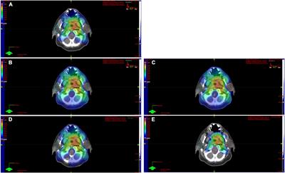 Transfer learning approach based on computed tomography images for predicting late xerostomia after radiotherapy in patients with oropharyngeal cancer